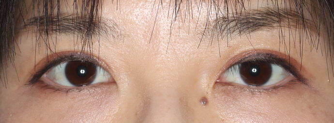 術後12ヶ月 開瞼