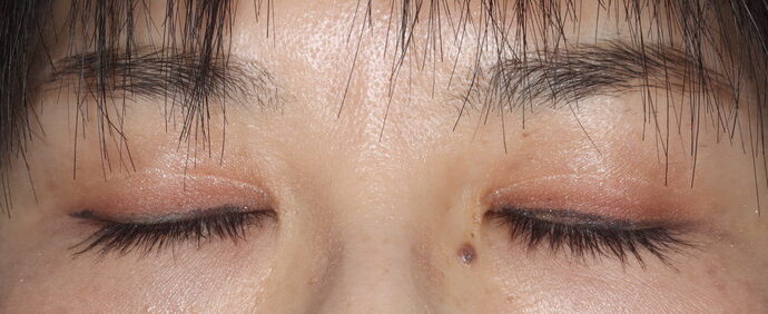 術後12ヶ月 閉瞼