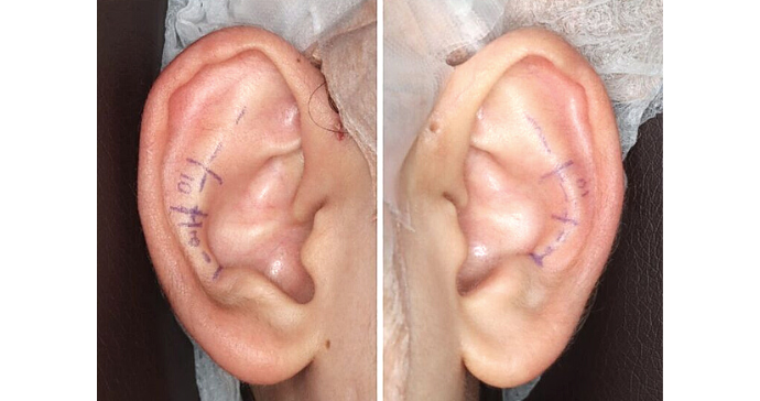 術前デザイン写真