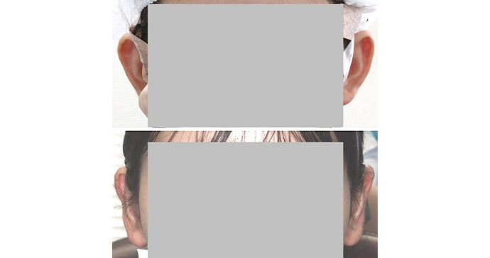 術前と術後の比較写真