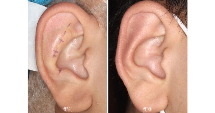 術前と術後の比較