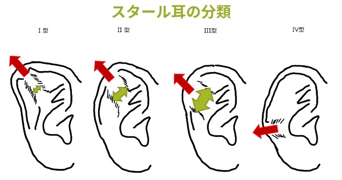 スタール耳の分類写真