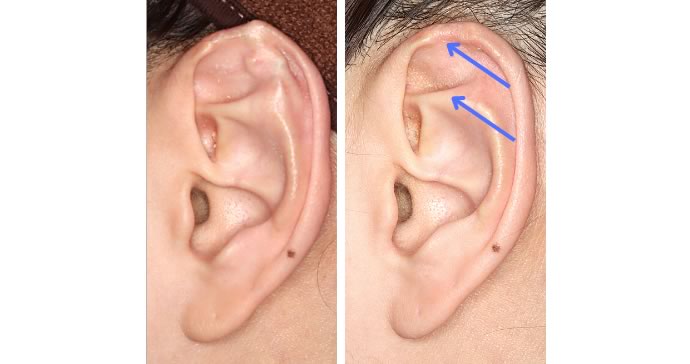 左 術前と術後の比較写真