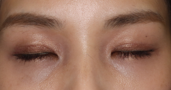 術後1ヶ月 閉瞼時