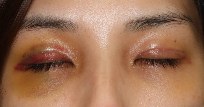 術後1週間 閉瞼時