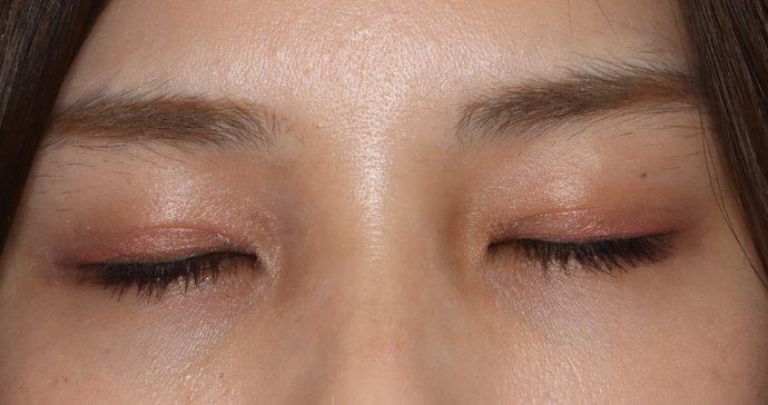 術後2ヶ月 閉瞼時