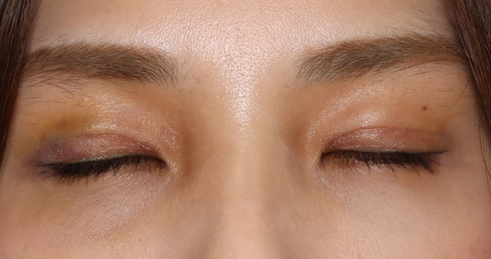 術後2週間 閉瞼時