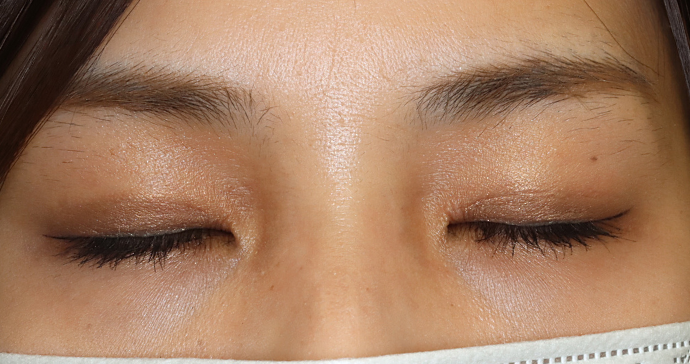 術後3ヶ月 閉瞼時