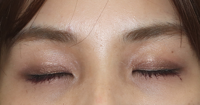 術後6ヶ月 閉瞼時