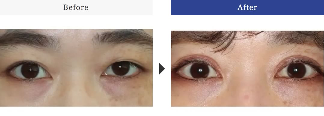 眼瞼下垂症手後（目の周り）