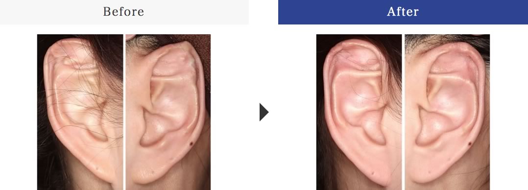 立ち耳（耳介形成術）手術後
