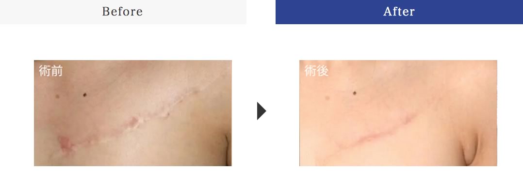 豊胸術後合併症（拘縮など）、脂肪吸引後の表面凹凸、タトゥー除去後の傷跡修正