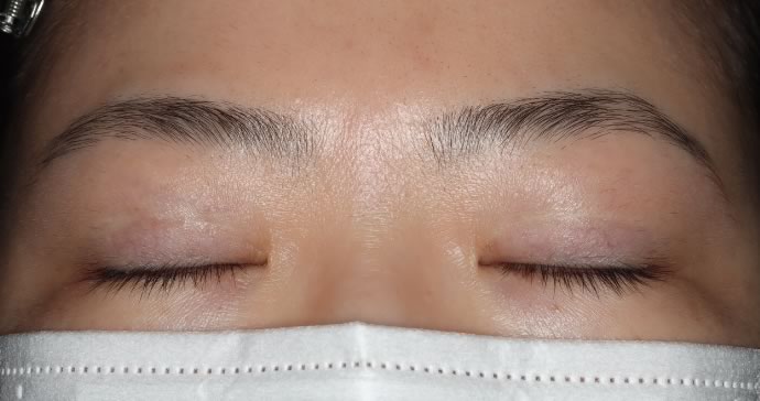 術後12ヶ月 閉瞼