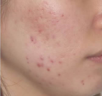 アゼライン酸1ヶ月使用