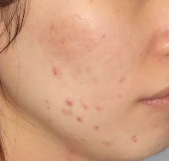 ジェネシス照射1回目1週間後