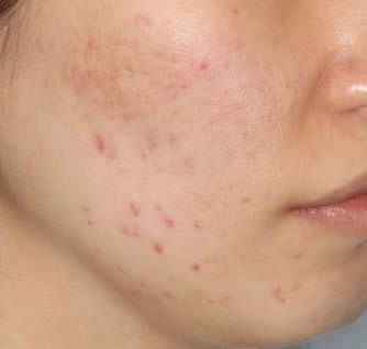 ジェネシス3回1週間後