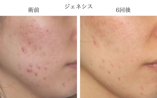 ジェネシス照射前と後