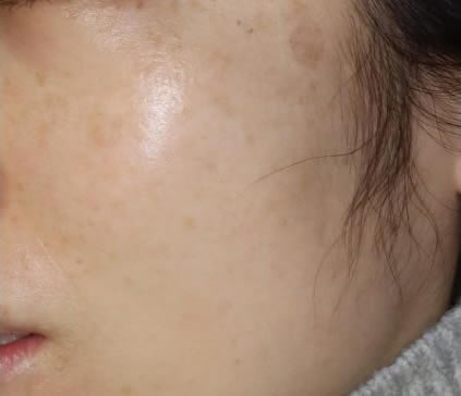 ピコレーザー照射10日後の写真