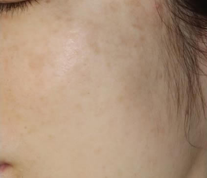 ピコレーザー2回目照射後2ヶ月の写真