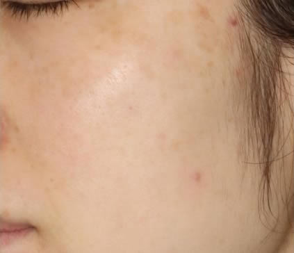 IPLとピコレーザーの併用治療の写真