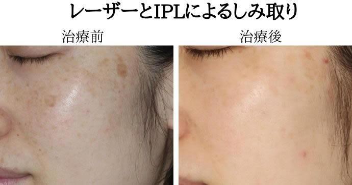 治療前と治療後の比較の写真