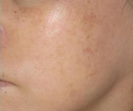 照射2回後の写真