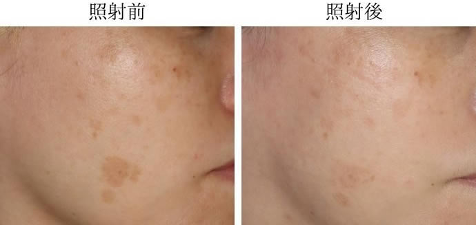 照射前と照射後の比較の写真