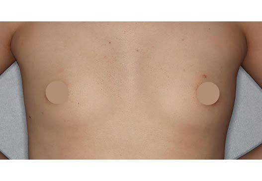 術前(正面)の写真