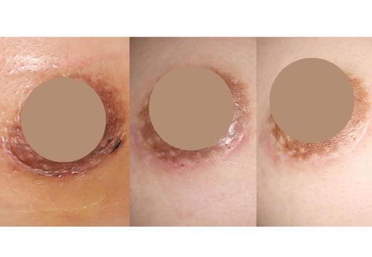 乳輪下切開アプローチ法による術後瘢痕(切開創部)の経過の写真