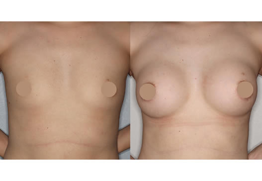 術前術後の写真(正面)の写真