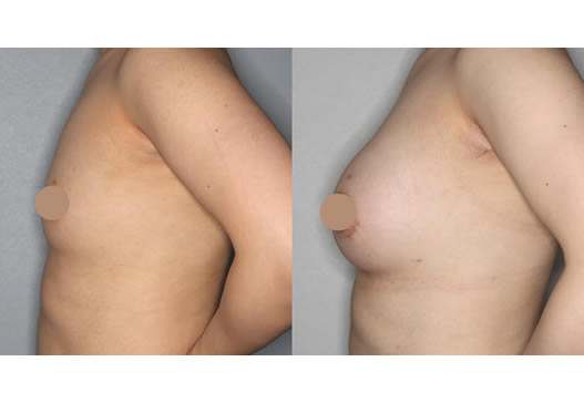 術前術後の写真(横)の写真