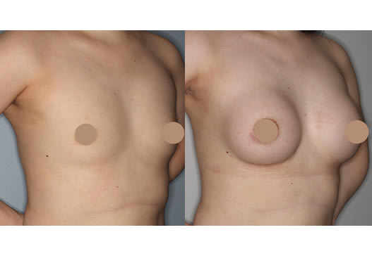 術前術後の写真(右斜め)の写真