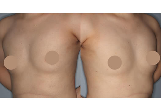 術前(左右斜め)の写真