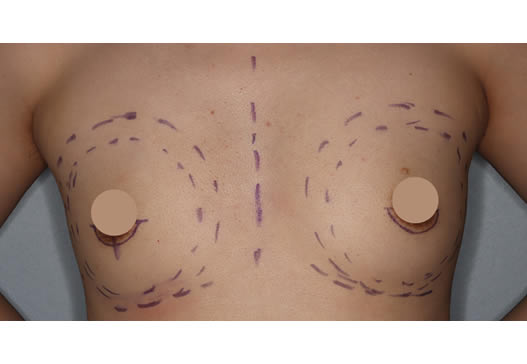 手術当日の写真