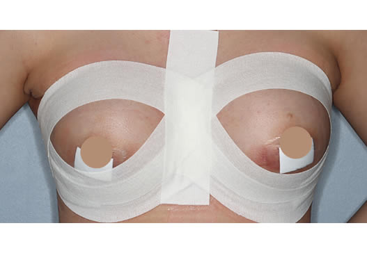 術後翌日の写真