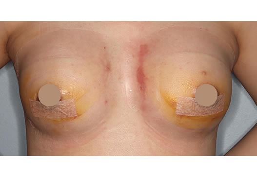 術後1週間(正面)の写真