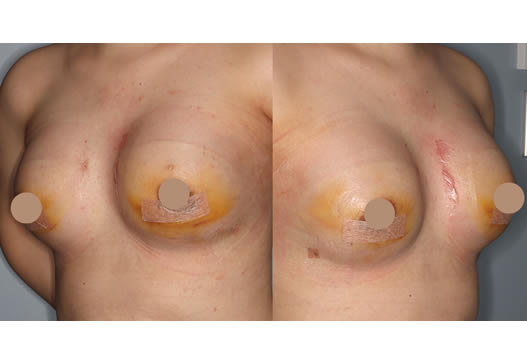 術後1週間(左右斜め)の写真