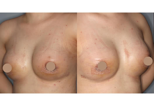 術後2週間(左右斜め)の写真