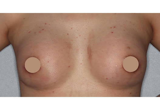 術後1ヶ月(正面)の写真