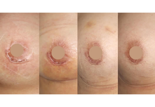 傷跡の経過の写真