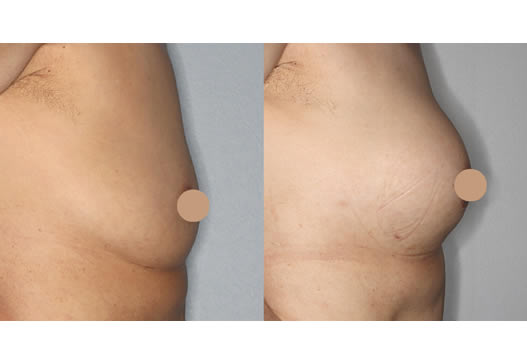 術前術後比較(横)の写真