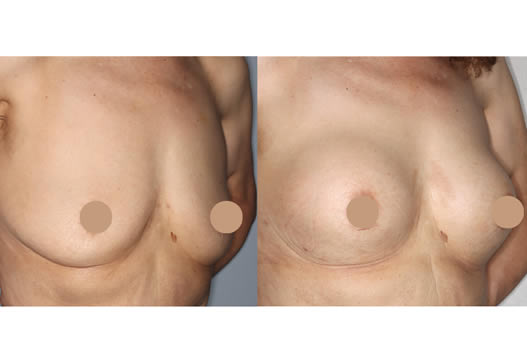 術前術後比較(斜め)の写真