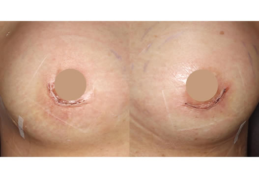 術後翌日の写真