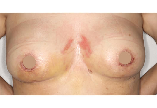 術後1週間(正面)の写真