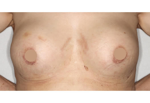 術後1ヶ月(正面)の写真