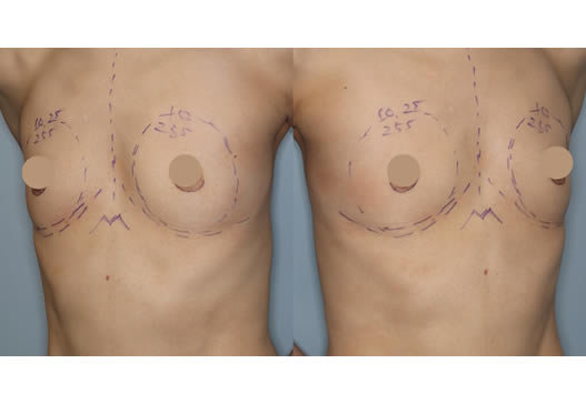 術前デザインの写真