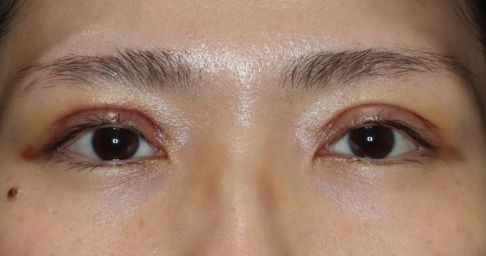 術後1週間の写真