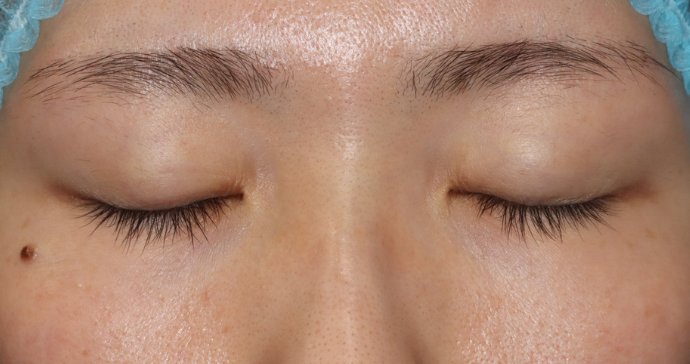 術前 閉瞼の写真