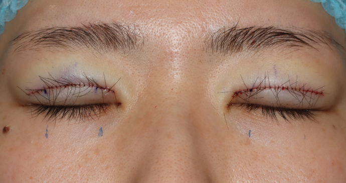 術直後 閉瞼の写真