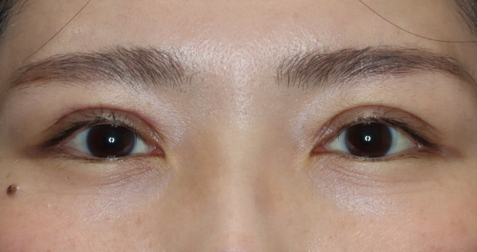 術後2週間の写真